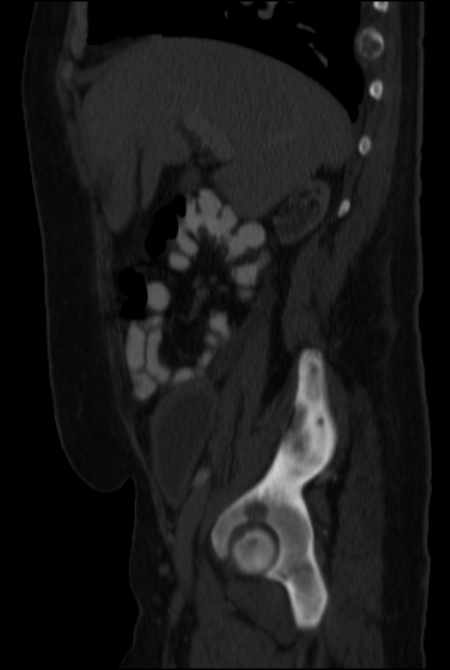 Brown tumors compressing the spinal cord (Radiopaedia 68442-77988 H 19).jpg