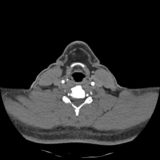 Buccal fat pad arteriovenous malformation (Radiopaedia 70936-81144 D 113).jpg
