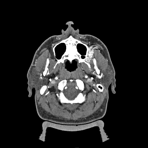 Buccal fat pad arteriovenous malformation (Radiopaedia 70936-81144 D 222).jpg