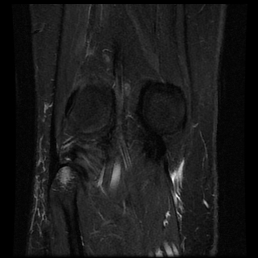 File:Bucket handle meniscus tear (Radiopaedia 56916-63751 Coronal STIR 16).jpg