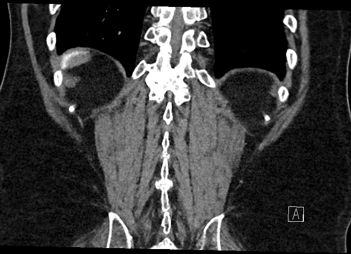 Buried bumper syndrome - gastrostomy tube (Radiopaedia 63843-72577 Coronal Inject 119).jpg