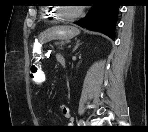 Buried bumper syndrome - gastrostomy tube (Radiopaedia 63843-72577 Sagittal Inject 46).jpg