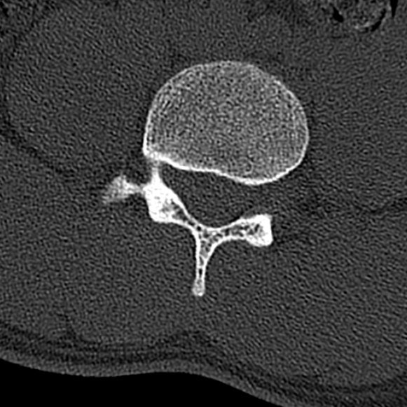 Burst fracture (Radiopaedia 53373-59357 Axial bone window 48).jpg