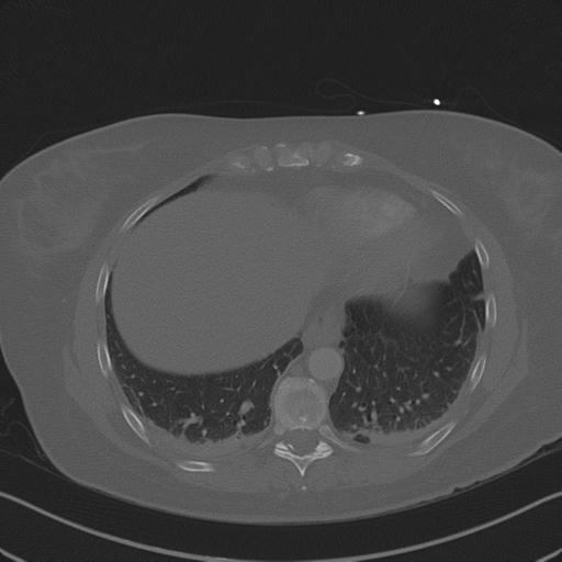 Burst fracture - thoracic spine (Radiopaedia 30238-30865 Axial bone window 68).jpg