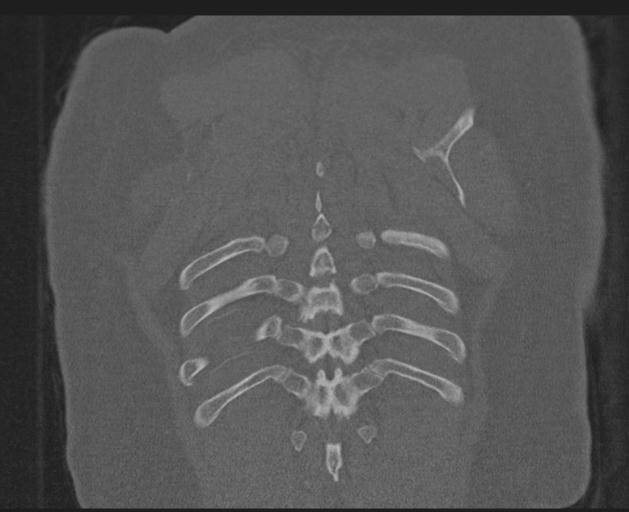 File:Burst fracture - thoracic spine (Radiopaedia 30238-30865 Coronal bone window 144).jpg