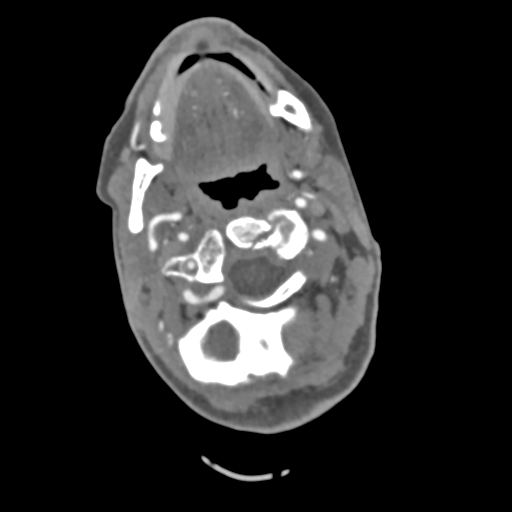 File:C2 fracture with vertebral artery dissection (Radiopaedia 37378-39200 A 172).png