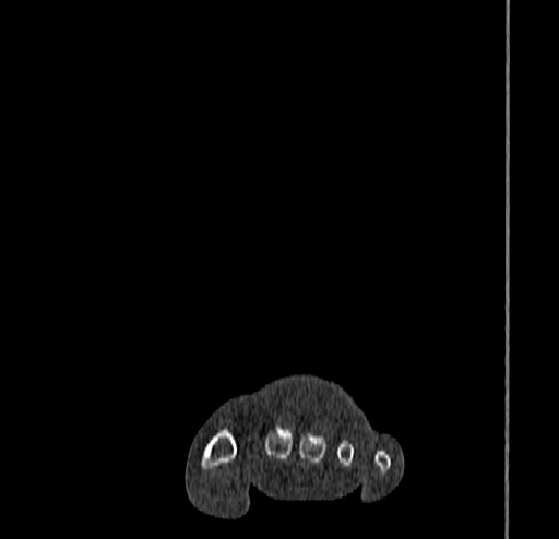 Calcaneal fracture - Sanders type 4 (Radiopaedia 90179-107370 Coronal bone window 17).jpg