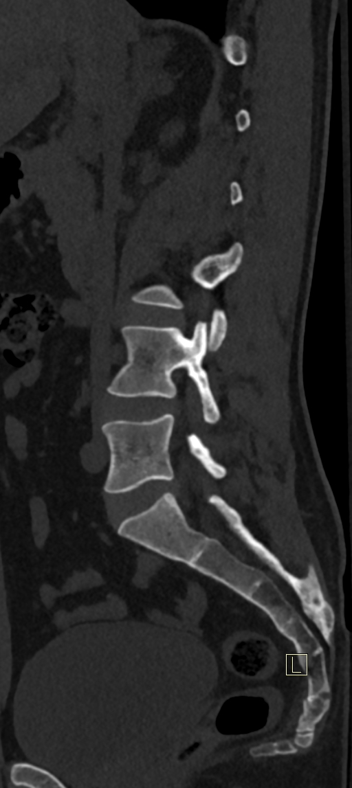 Calcaneal fractures with associated L2 burst fracture (Radiopaedia 71671-82493 Sagittal bone window 51).jpg