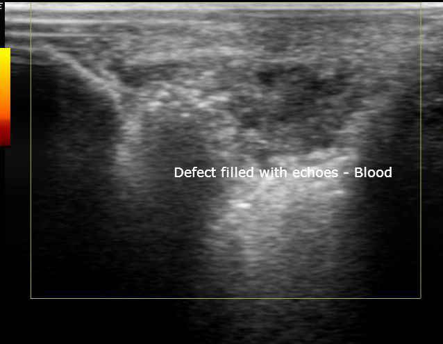 File:Calcaneal tuberosity avulsion fracture - ultrasound (Radiopaedia 29978-30524 D 1).jpg