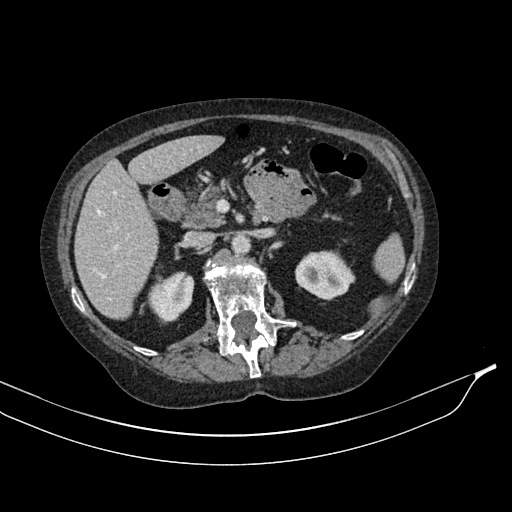 Calcified adrenal glands and Spigelian hernia (Radiopaedia 49741-54988 A 73).jpg