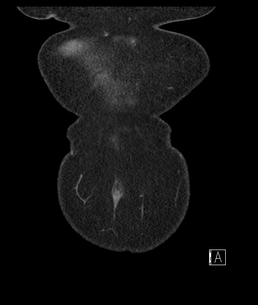 Calcified adrenal glands and Spigelian hernia (Radiopaedia 49741-54988 B 7).jpg
