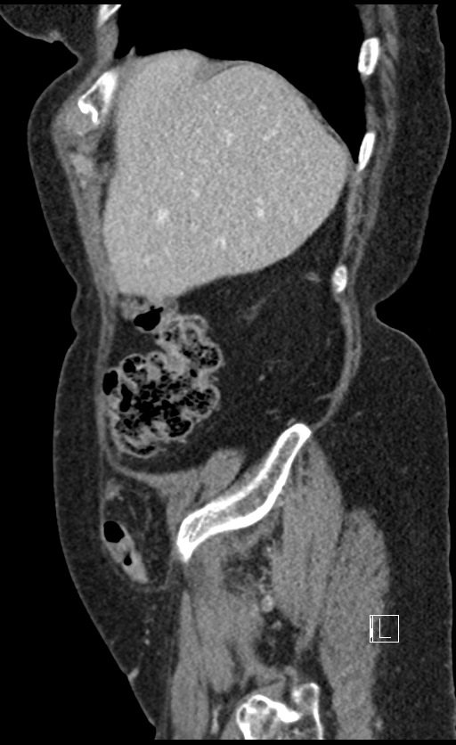 Calcified adrenal glands and Spigelian hernia (Radiopaedia 49741-54988 C 137).jpg
