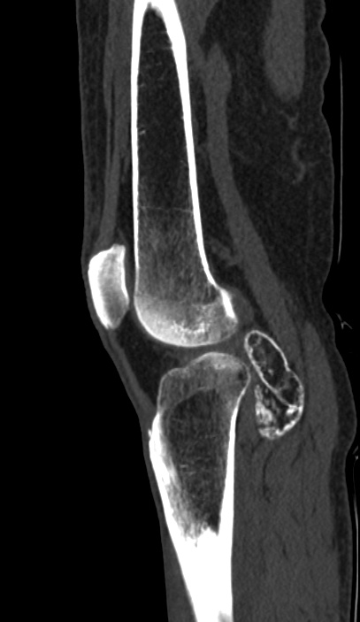Calcified hematoma - popliteal fossa (Radiopaedia 63938-72763 Sagittal bone window 72).jpg