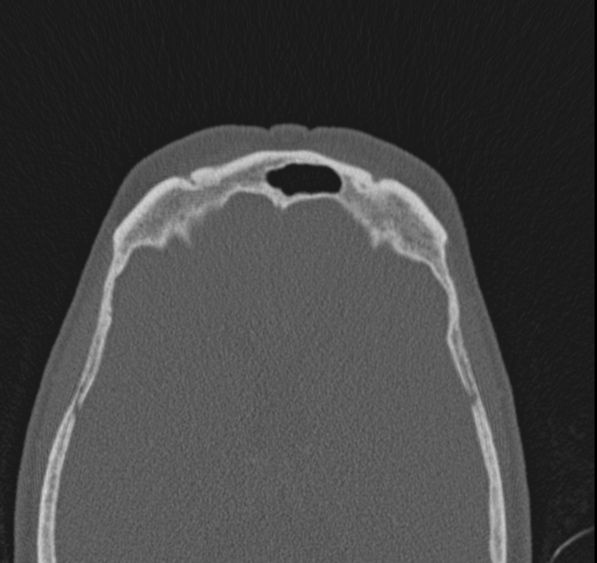 Caldwell-Luc operation (Radiopaedia 52329-58225 Axial bone window 12).jpg