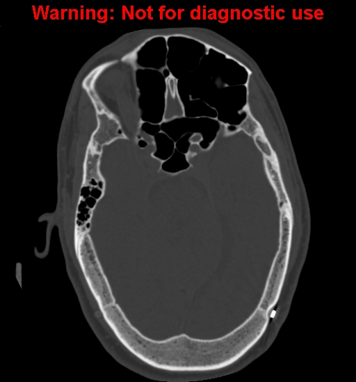 File:Calvarial thickening from chronic shunting (Radiopaedia 60079-67637 Axial bone window 67).jpg