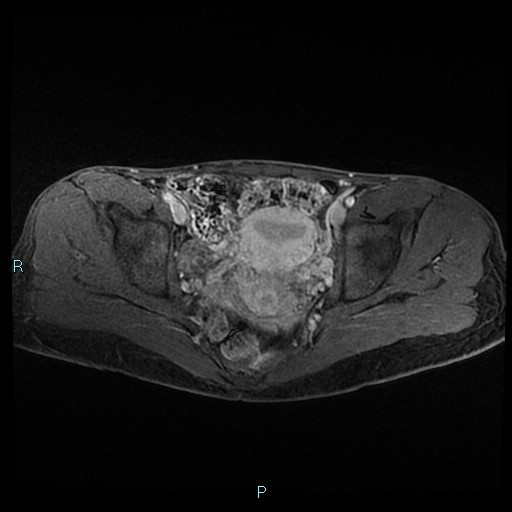 File:Canal of Nuck cyst (Radiopaedia 55074-61448 Axial T1 C+ fat sat 32).jpg
