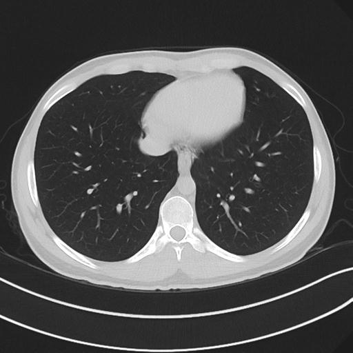 File:Cannabis ('bong') smoking induced pneumomediastinum and subcutaneous emphysema (Radiopaedia 29947-30479 C 58).jpg