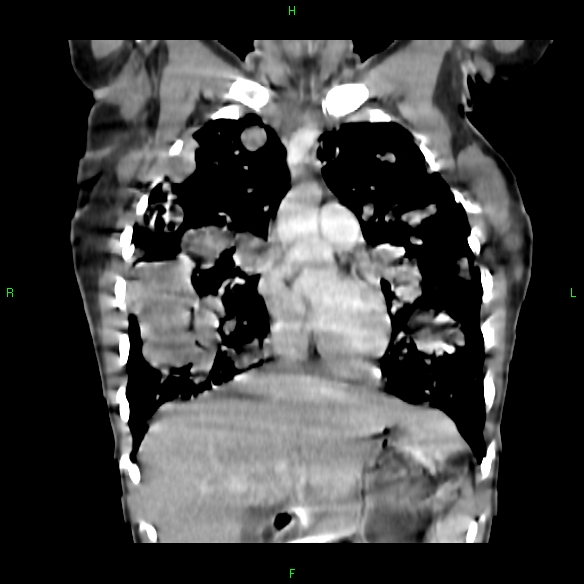 File:Cannon ball metastases - synovial sarcoma (Radiopaedia 26135-26271 Coronal liver window 5).jpg