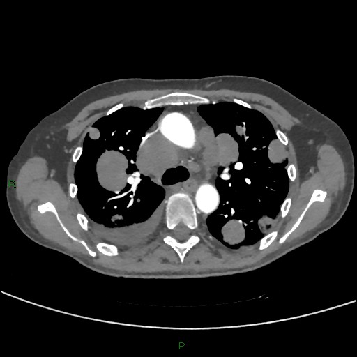 Cannonball metastases (Radiopaedia 82110-96150 Axial C+ CTPA 123).jpg