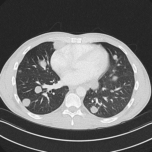 Cannonball metastases - testicular choriocarcinoma (Radiopaedia 84510-99891 Axial lung window 62).jpg