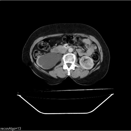 File:Carcinoma cervix- recurrence (Radiopaedia 34702-36137 B 23).jpg