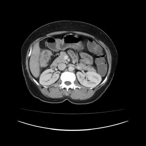 File:Carcinoma colon - hepatic flexure (Radiopaedia 19461-19493 A 48).jpg