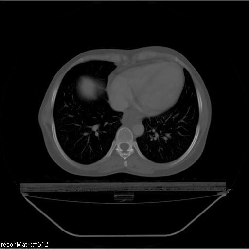 File:Carcinoma of esophagus (Radiopaedia 27356-27550 Axial bone window 12).jpg