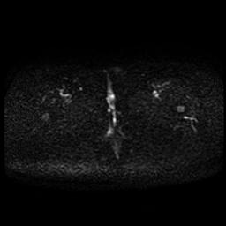 Carcinoma of the cervix (Radiopaedia 89018-105858 Axial DWI 1).jpg