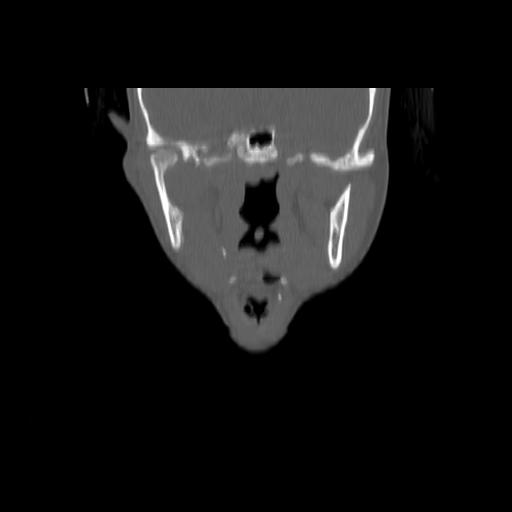 Carcinoma of the maxillary antrum (Radiopaedia 53805-59888 Coronal bone window 75).jpg