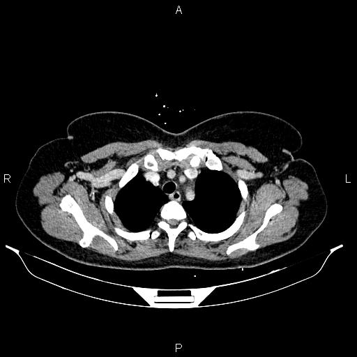Carcinoma of uterine cervix (Radiopaedia 85861-101700 A 10).jpg