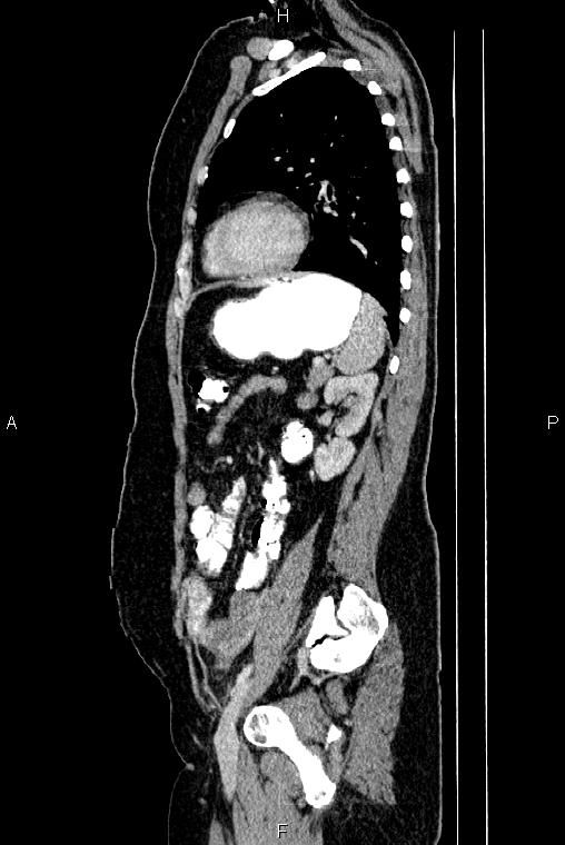 Carcinoma of uterine cervix (Radiopaedia 85861-101700 D 60).jpg