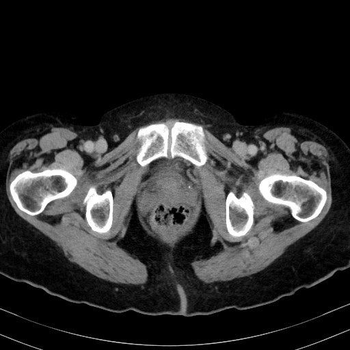 Carcinosarcoma (Radiopaedia 70401-80503 A 69).jpg