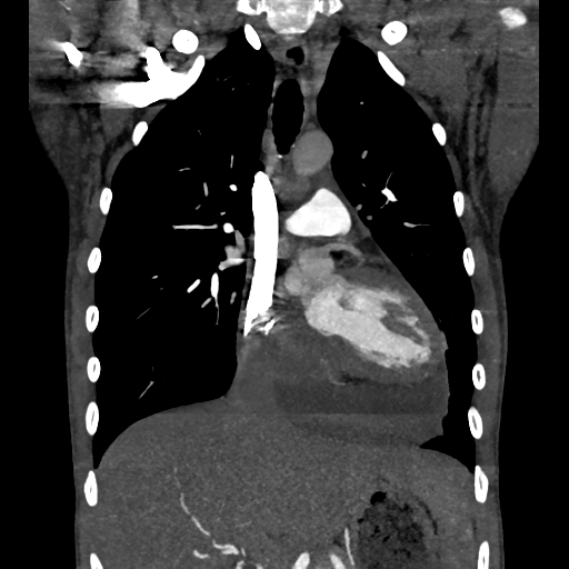 File:Cardiac tumor - undifferentiated pleomorphic sarcoma (Radiopaedia 45844-50134 Coronal non-contrast 29).png