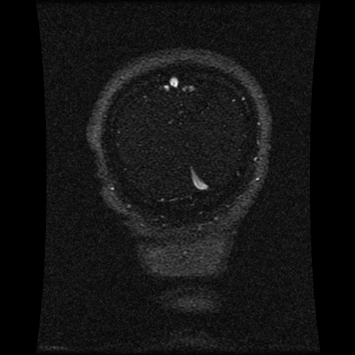 File:Carotid arterial dissection with acute cerebral infarction (Radiopaedia 26636-26784 MRV 40).jpg