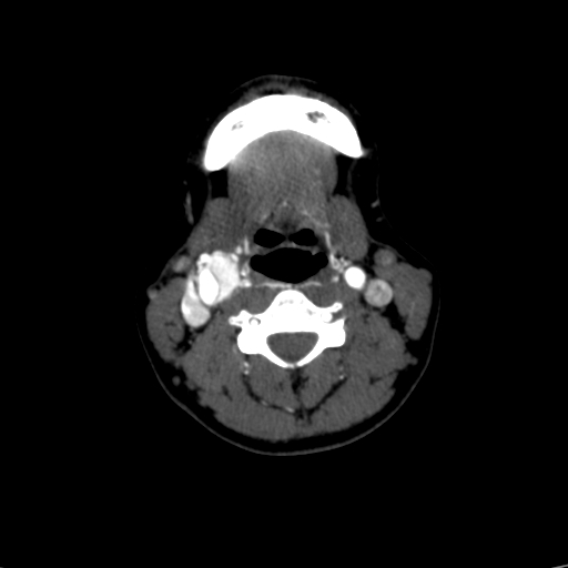 File:Carotid body tumor (Radiopaedia 39845-42300 B 30).jpg