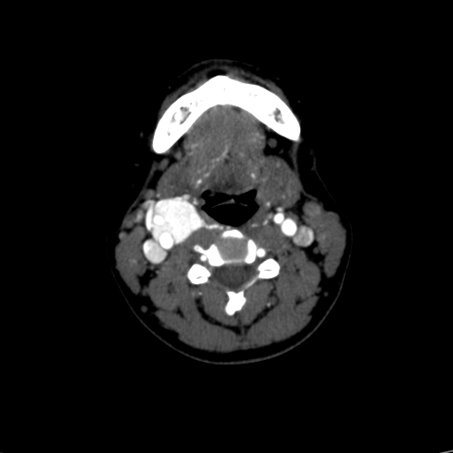 File:Carotid body tumor (Radiopaedia 39845-42300 B 34).jpg