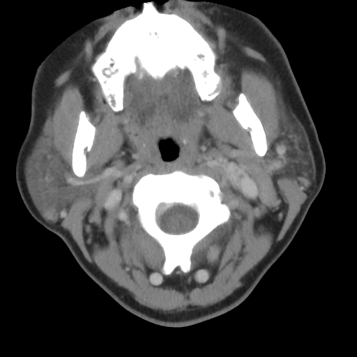 Carotid body tumor (paraganglioma) (Radiopaedia 38586-40729 A 11).jpg