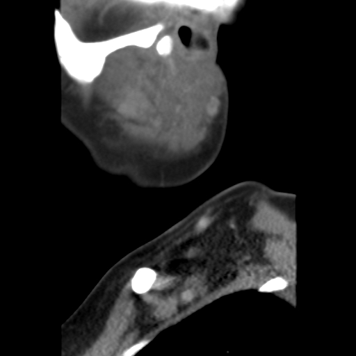 File:Carotid body tumor (paraganglioma) (Radiopaedia 38586-40729 C 6).jpg