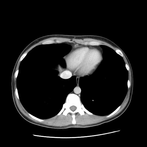 Castleman disease with fibrous pseudotumor in the abdomen (Radiopaedia 77296-89373 A 11).jpg