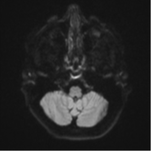 File:Cavernoma with bleed - midbrain (Radiopaedia 54546-60774 Axial DWI 32).png