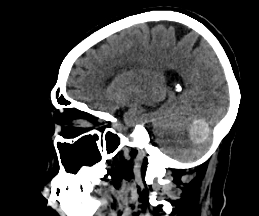 Cavernous hemangioma of the cerebellar falx (Radiopaedia 73025-83723 B 208).jpg