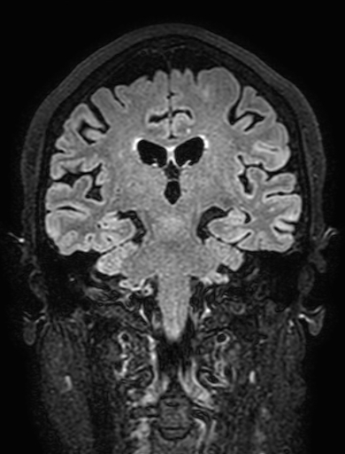 Cavernous hemangioma of the cerebellar falx (Radiopaedia 73025-83724 Coronal FLAIR 200).jpg