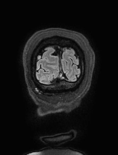 Cavernous hemangioma of the cerebellar falx (Radiopaedia 73025-83724 Coronal FLAIR 340).jpg