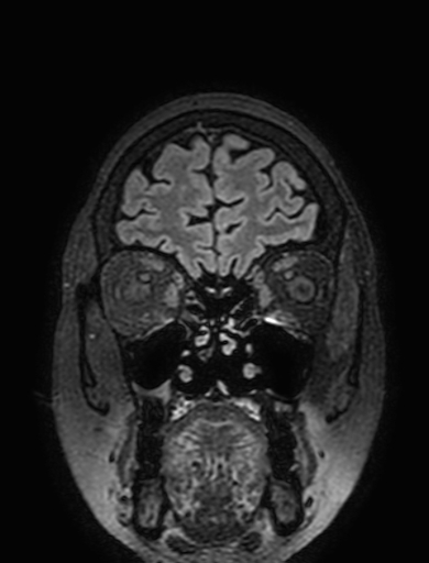Cavernous hemangioma of the cerebellar falx (Radiopaedia 73025-83724 Coronal FLAIR 50).jpg