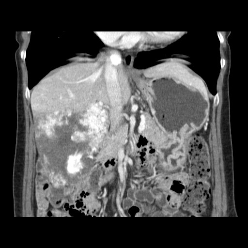 Cavernous hepatic hemangioma (Radiopaedia 75441-86667 C 64).jpg