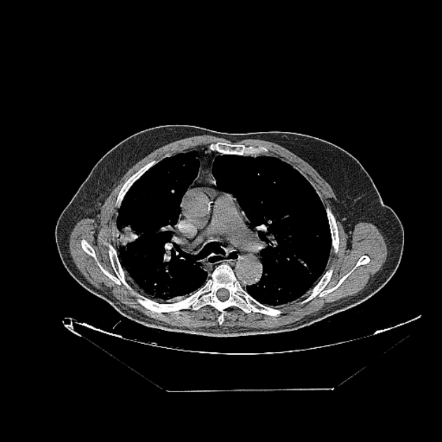 Cavitating bronchogenic carcinoma (Radiopaedia 44489-48162 Axial non-contrast 32).jpg