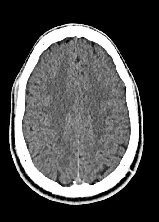 Cavum septum pellucidum and cavum vergae (Radiopaedia 77797-90060 Axial Brain Window 76).jpg