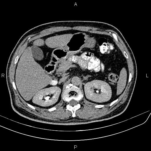 File:Cecal cancer with appendiceal mucocele (Radiopaedia 91080-108651 Axial C+ delayed 14).jpg