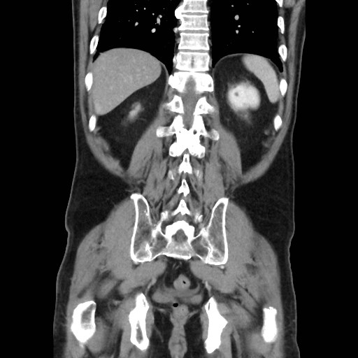 Cecal mass causing appendicitis (Radiopaedia 59207-66531 B 41).jpg