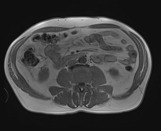 Cecal mass causing appendicitis (Radiopaedia 59207-66532 Axial T1 in-phase 75).jpg